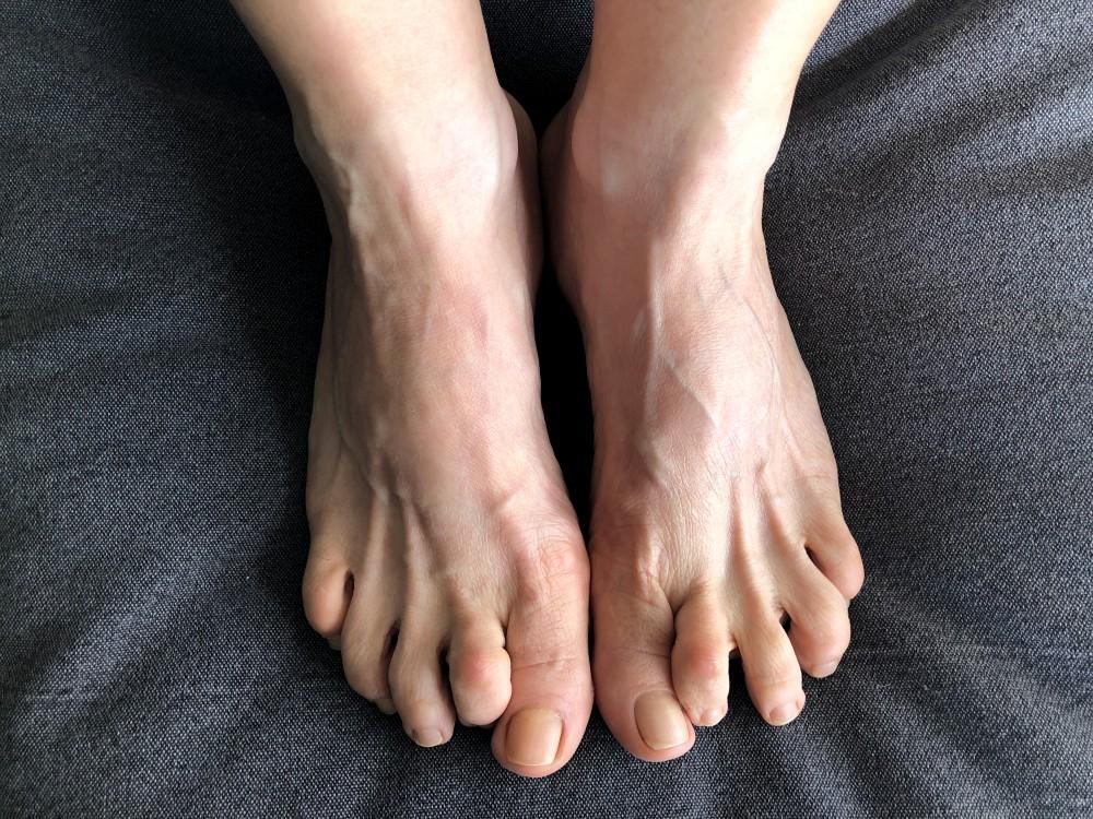 Hammer toe shoe inserts deals
